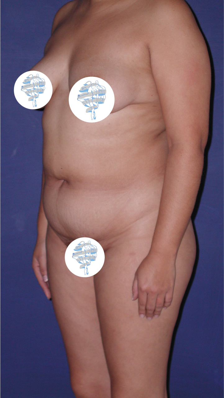 Before-Abdominoplastia
