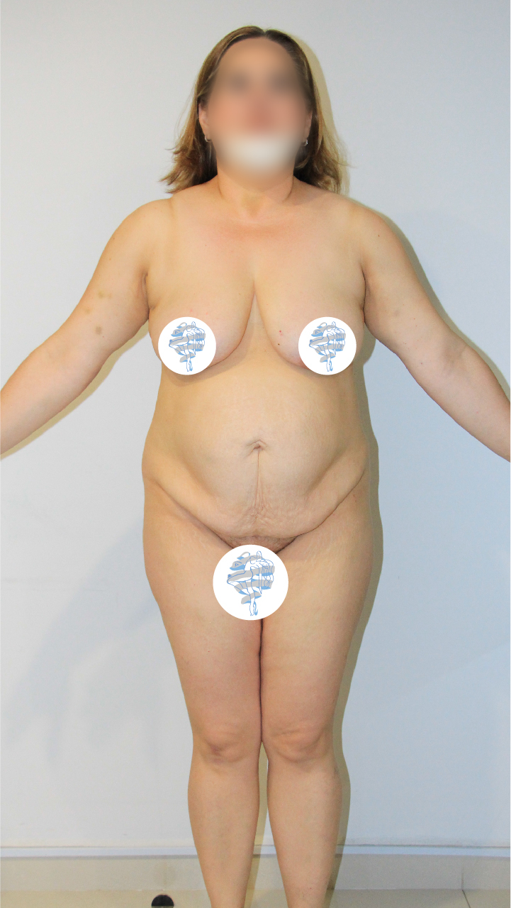 Before-Abdominoplastia