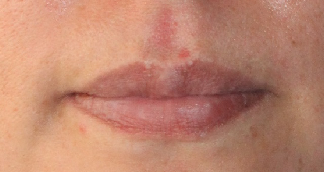 Before-Aumento de labios