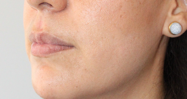 Before-Aumento de labios