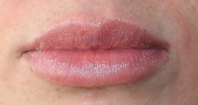 After-Aumento de labios