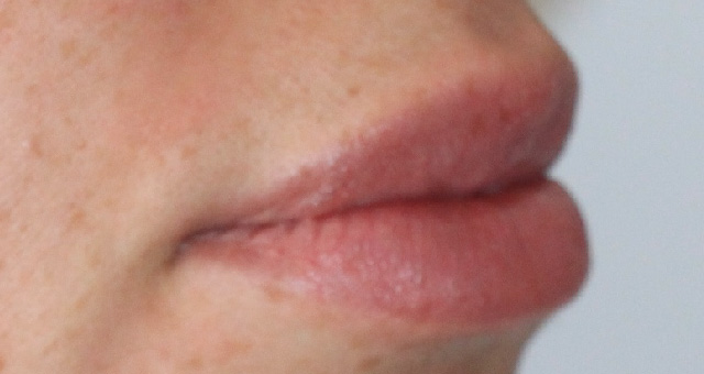 After-Aumento de labios